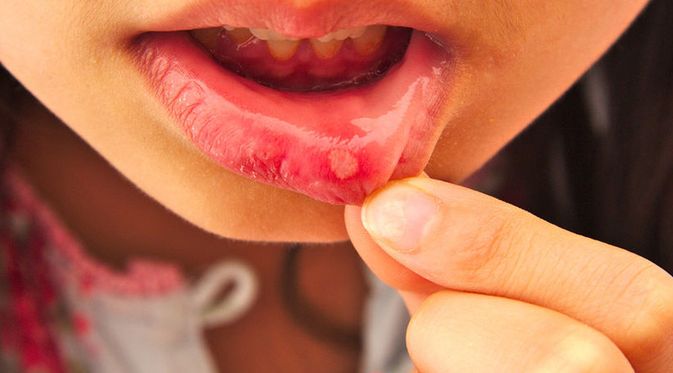 Penyakit Sariawan - Gejala, Penyebab, Pengobatan - Klikdokter.com